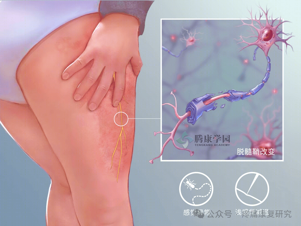 股外侧皮神经损伤