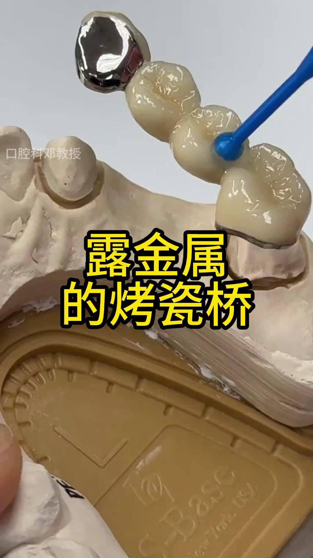 露金属的烤瓷桥口腔科普 烤瓷牙 口腔科邓教授
