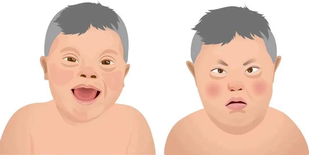 ,还可能伴有多种器官畸形,如先天性