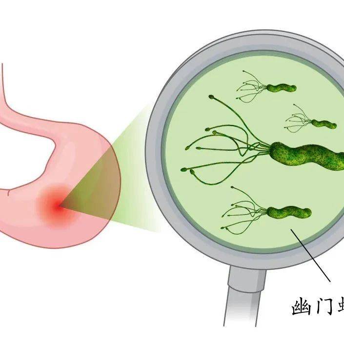 如何提高幽门螺杆菌的根除成功率_患者_抗生素_方案