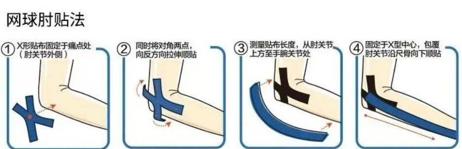 胳膊肘疼,有可能是网球肘!