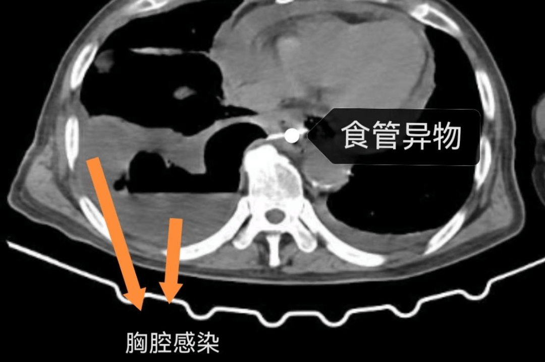 进行胸部ct检查时发现,其食管下段有硬质异物,导致食管穿孔,穿孔后纵