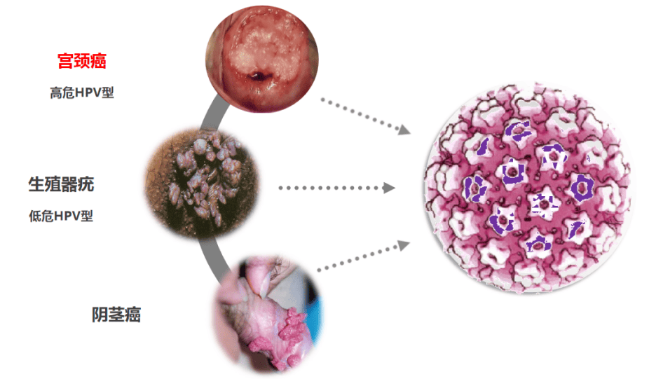关爱女性健康 从预防宫颈癌开始