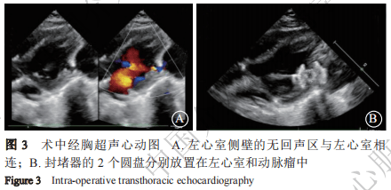 病例报告丨经皮封堵治疗先天性心脏病术后新发左心室假性室壁瘤1例
