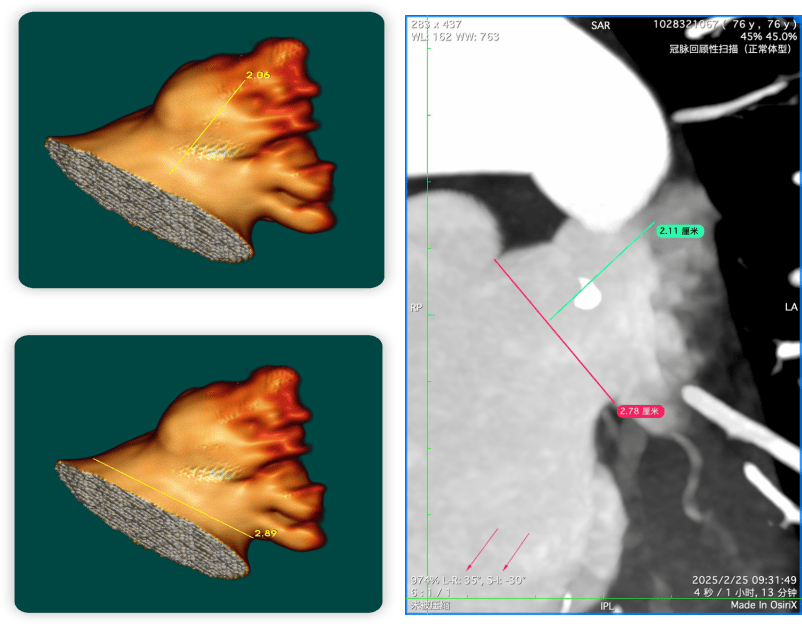 结合术前左心房增强ct影像学显示的左心耳解剖特点,团队最终决定应用