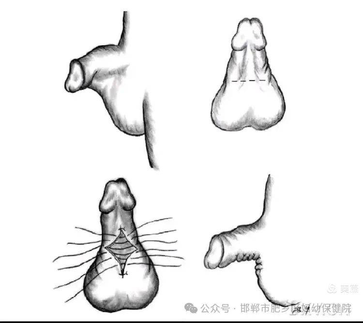诊断蹼状阴茎通常通过体检即可诊断,医生会检查阴茎和阴囊的皮肤连接