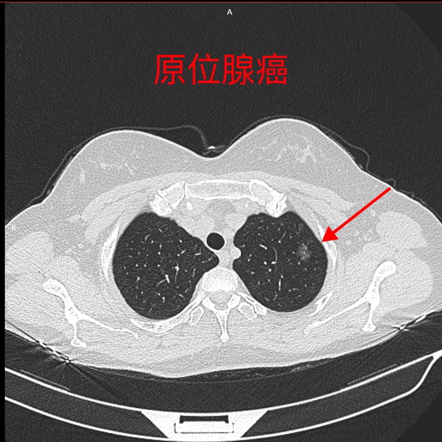 北京大学国际医院胸外科科普系列