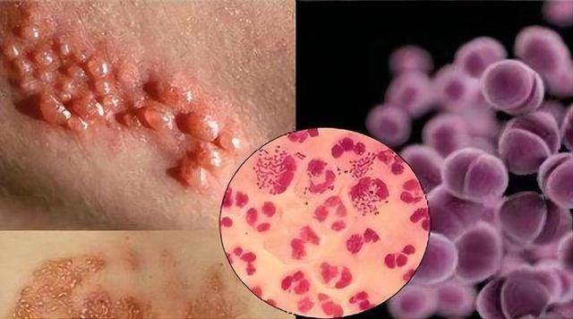 28岁女子确诊淋病,她的亲身经历,为所有人敲响警钟