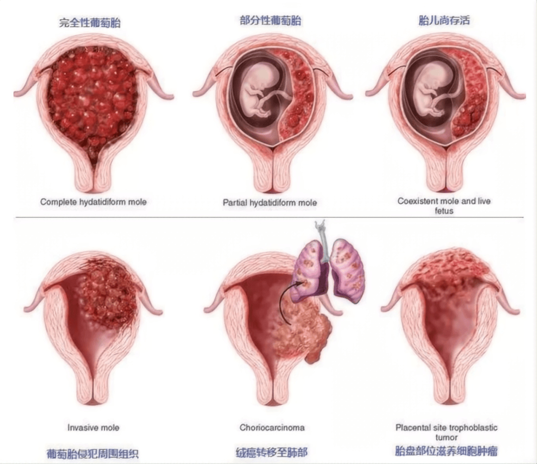 新闻 | 欣喜怀孕,却被告知是"葡萄胎",这可怎么办?