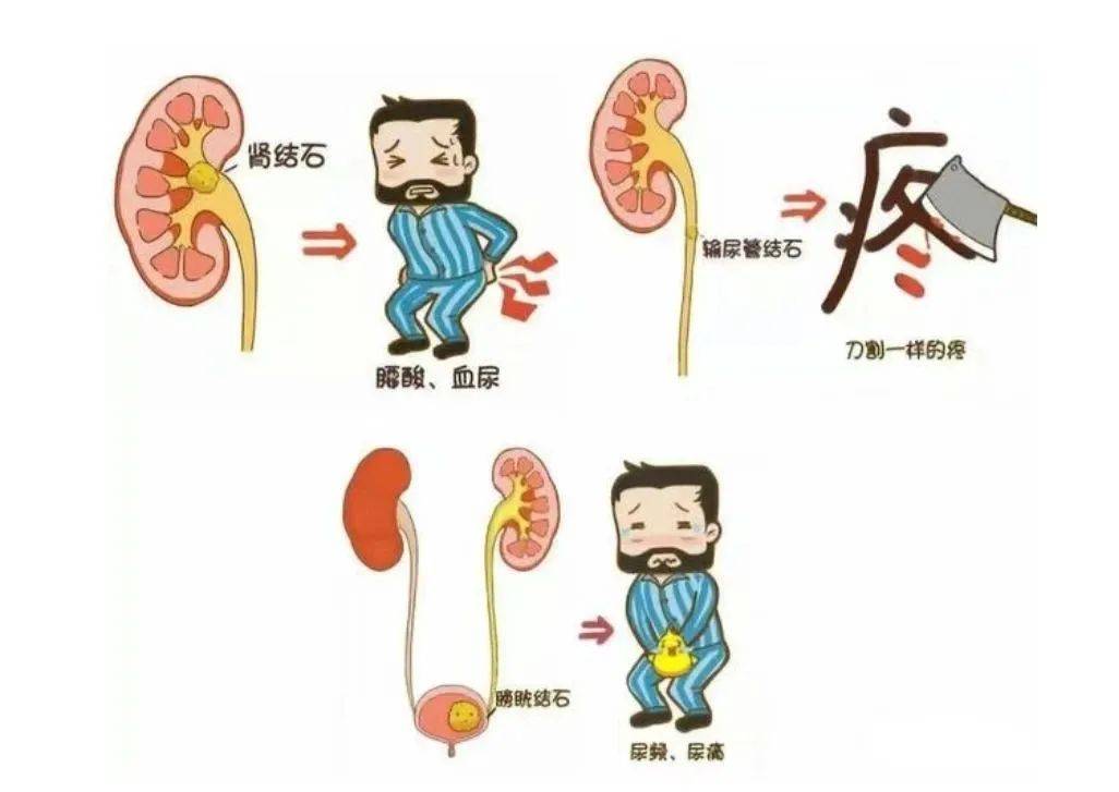 省四院科普:"疯狂的结石"带您了解泌尿系结石