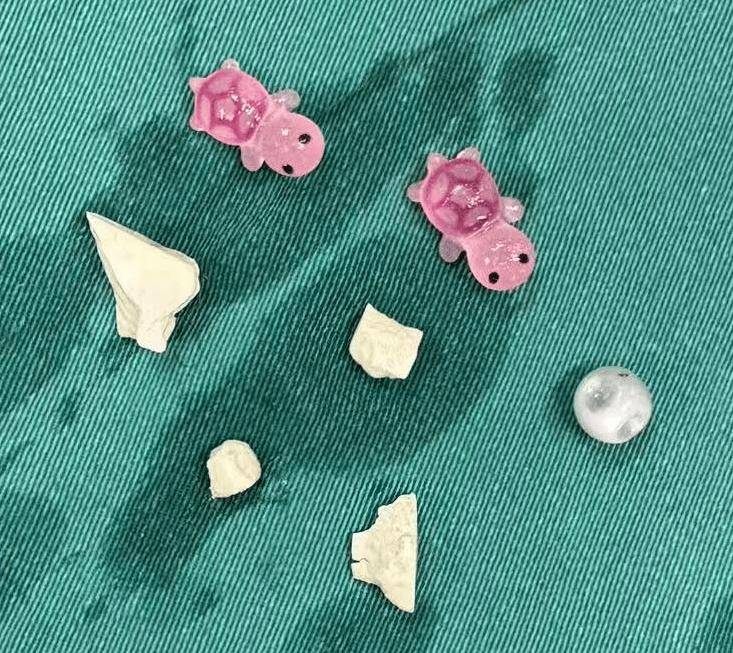 6岁女孩私处脓性分泌物,异味,居然是这个原因,宝妈们忽略了这点