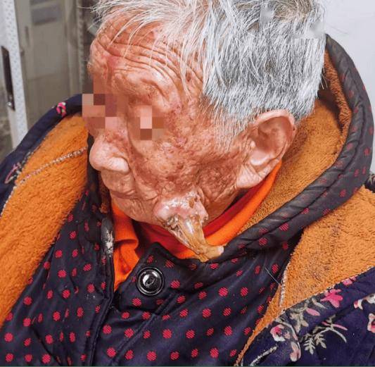 皮肤_角质_患者