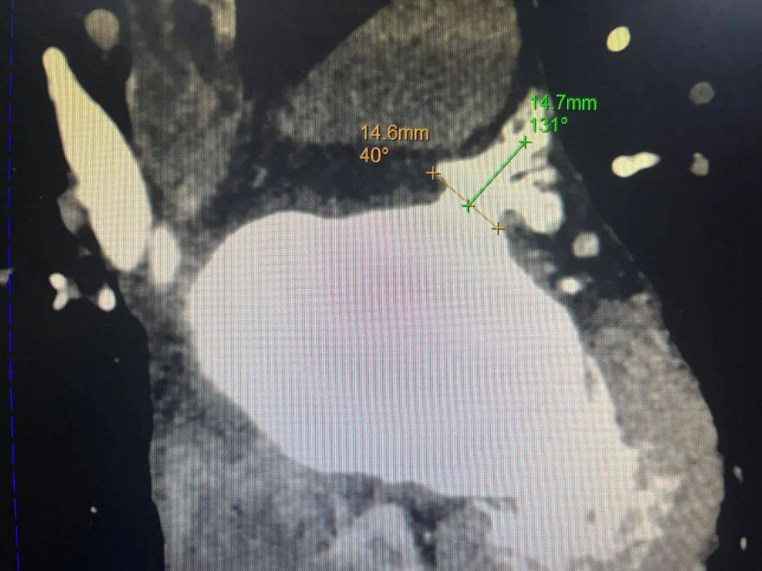 术前cta患者入院诊断及评分术者:燕翼 教授医院:广州医科大学附属第三