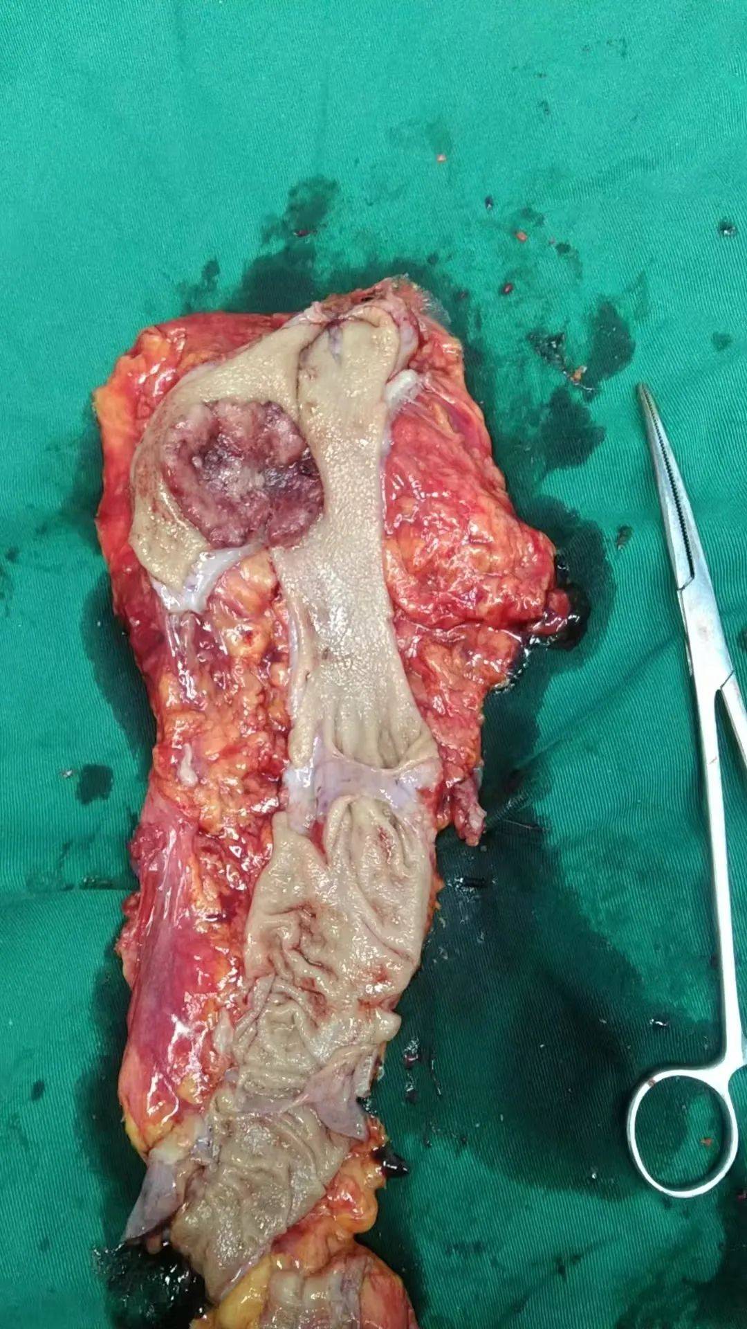 外二科再创佳绩,独立成功完成第一例腹腔镜辅助下低位直肠癌根治术