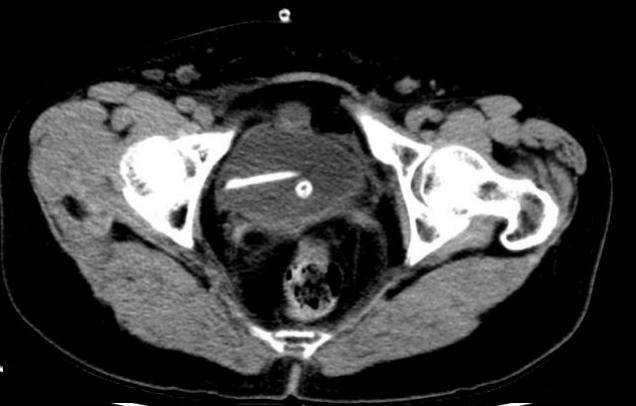 攻克复杂输尿管狭窄