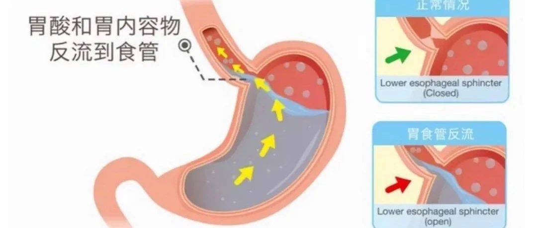 胃食管反流，你还在这样吃睡？_症状_食物_括约肌