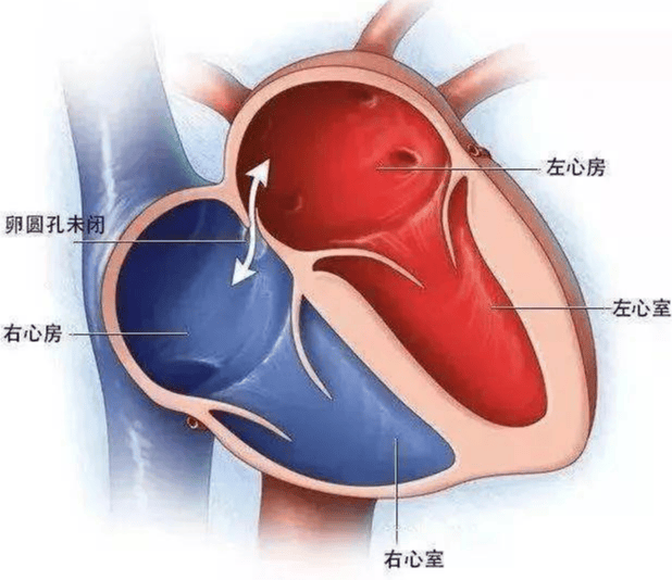 宝宝心脏里这个"小洞",需要治疗吗?