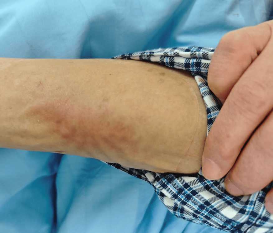 我立即意识到,可能发生了药物外渗性静脉炎.第2 天,再次