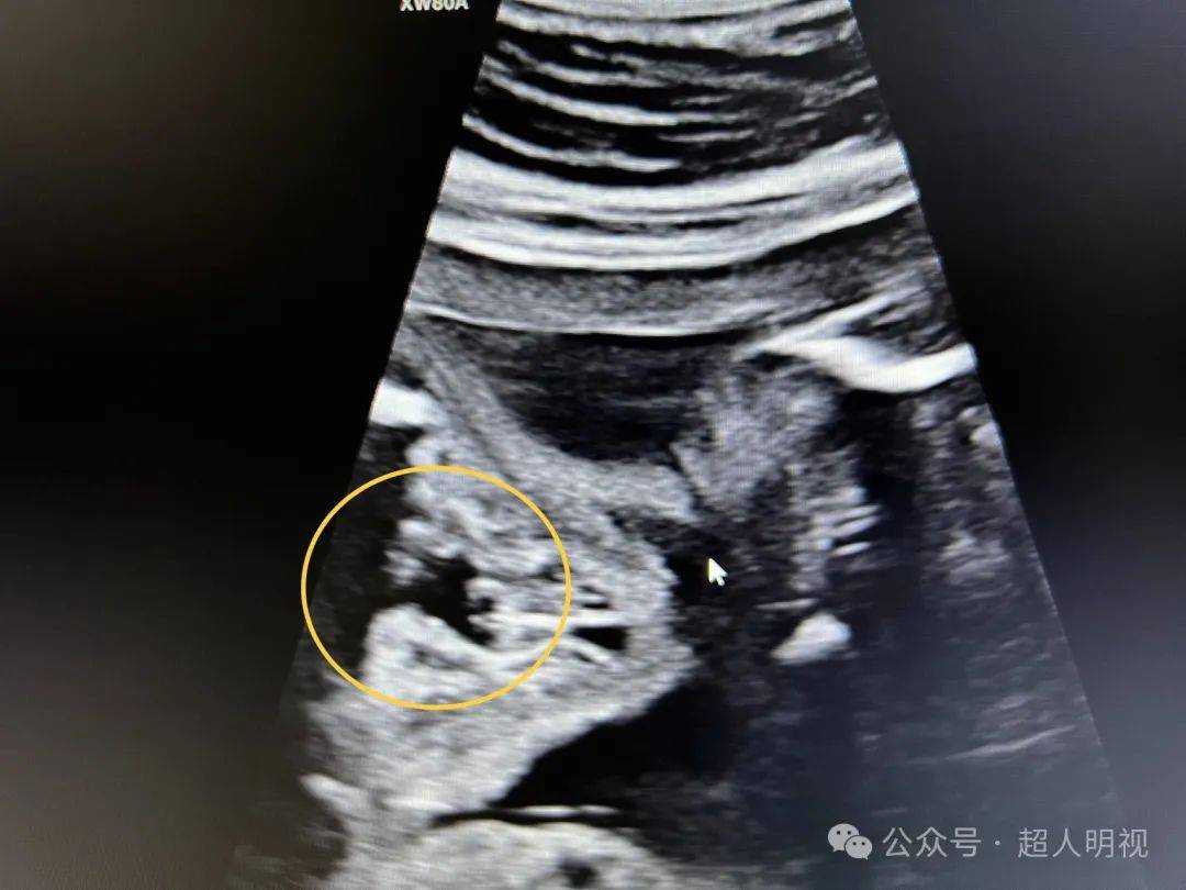 诊断胎儿唇腭裂思路及病例