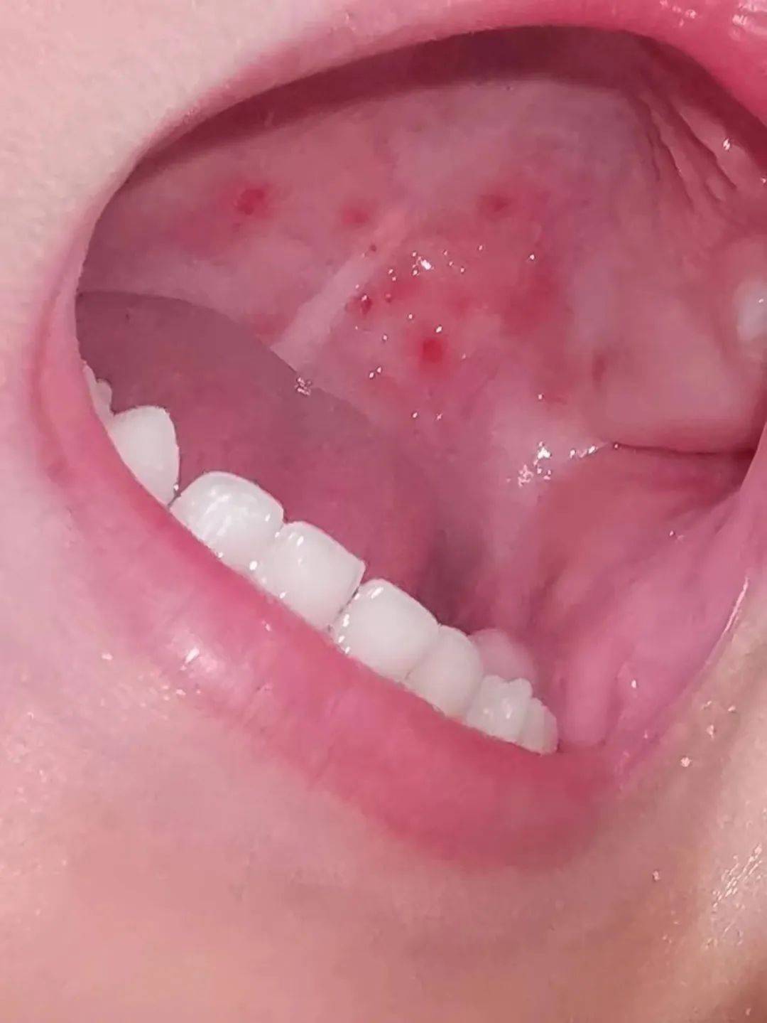 疱疹性咽峡炎来袭,宝爸宝妈别慌!超全科普在这里