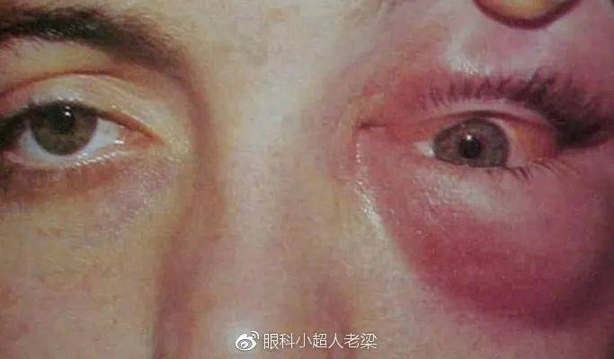 眼睑肿,是过敏吗?