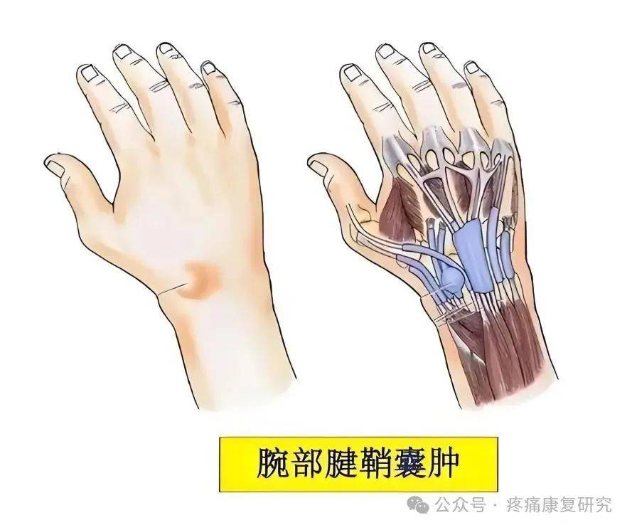 腱鞘囊肿是一种发生在关节囊或腱鞘附近的囊性肿物,内含无色透明或淡