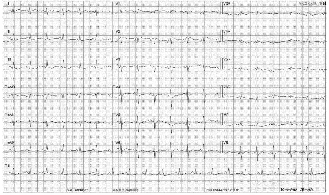 患者突发宽 qrs 波心动过速,抢救无效死亡!临床需警惕