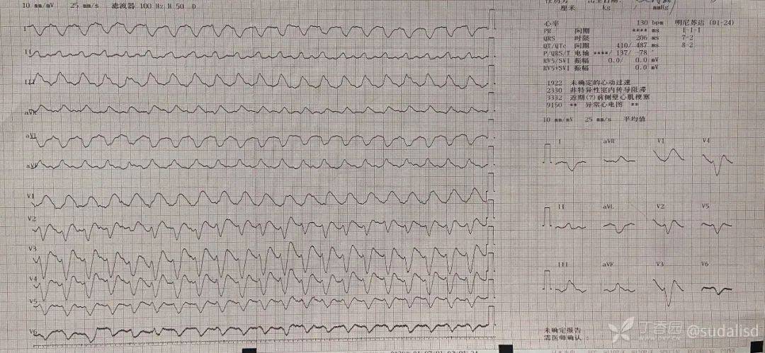 患者突发宽 qrs 波心动过速,抢救无效死亡!临床需警惕
