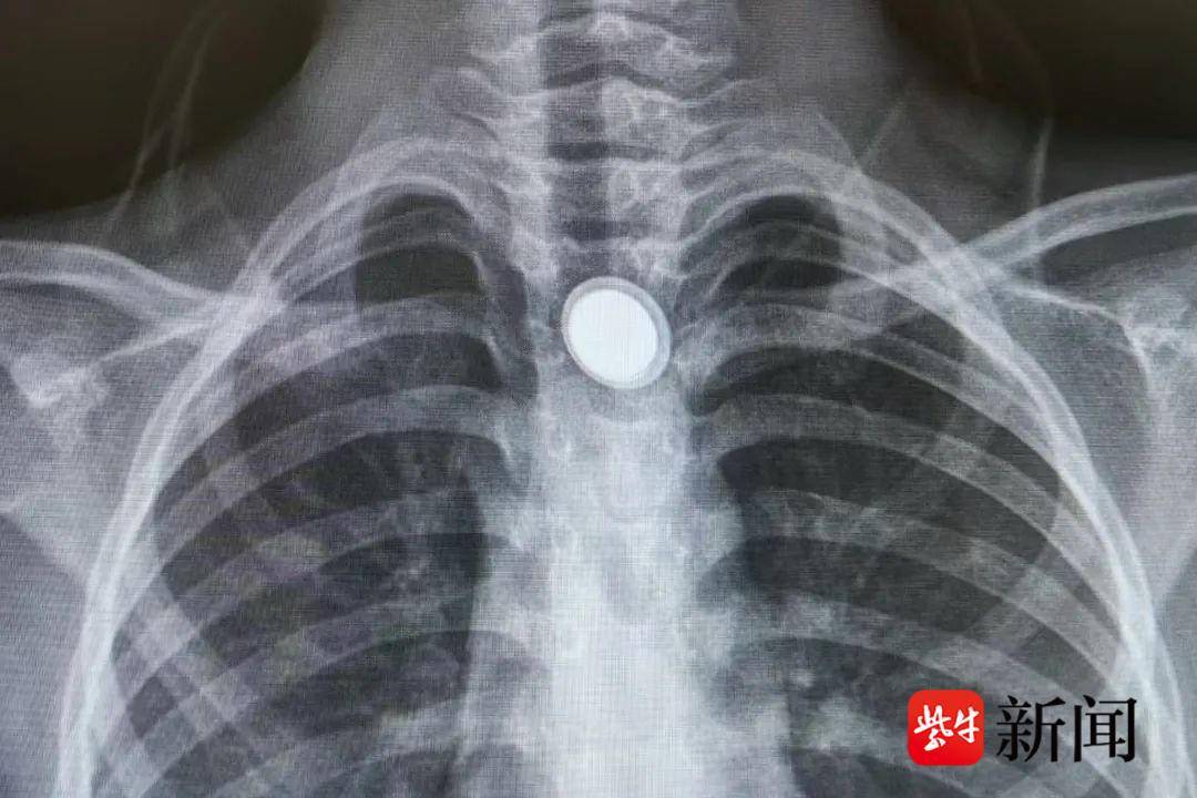 误食磁力球能排出来吗=不小心把磁力球咽肚子里