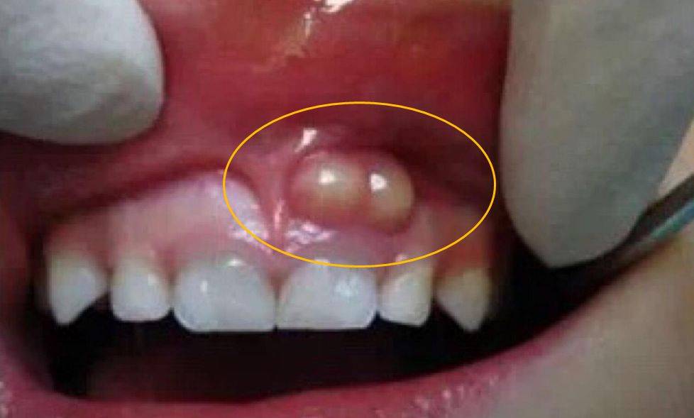 瘘管,窦道,脓包?牙龈长脓包:一直刺破风险大!