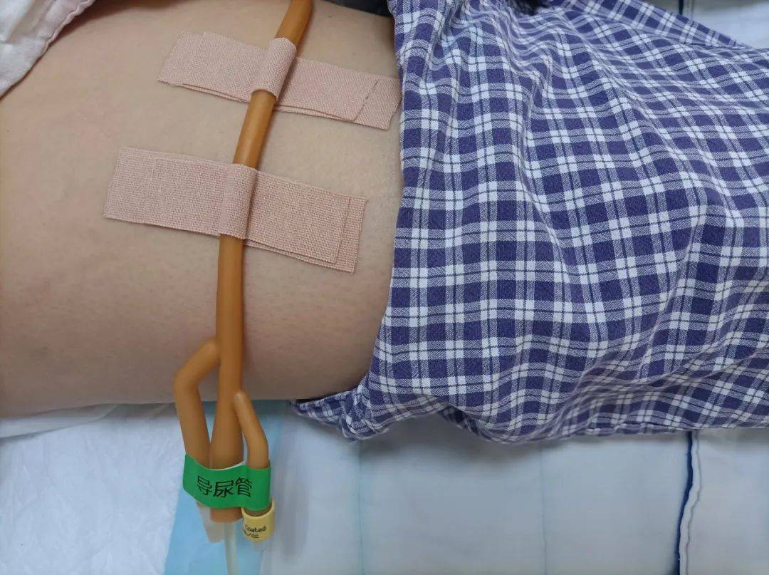 尿管居家护理攻略