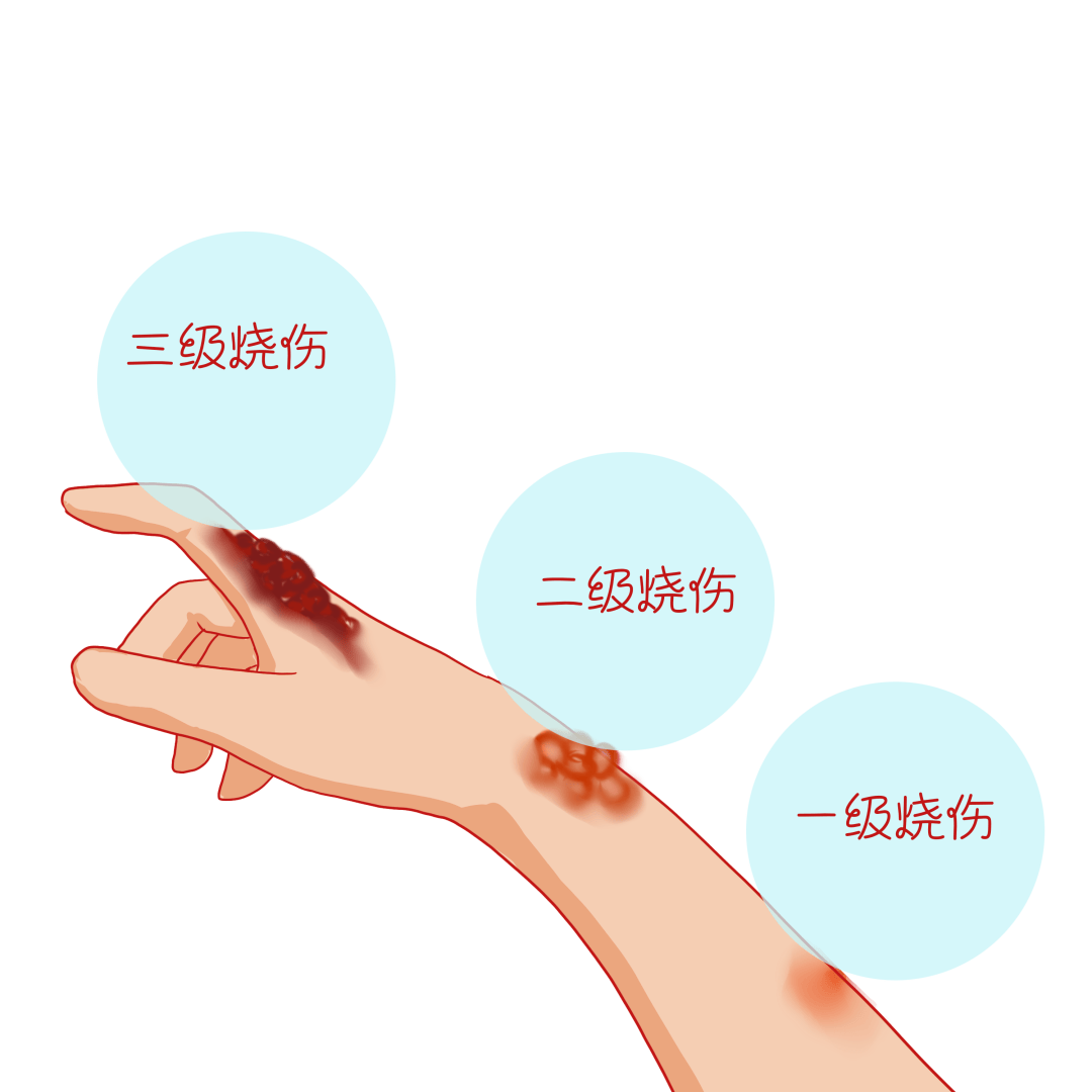 烧烫伤后皮肤一定会留疤吗?学会这三点很关键!