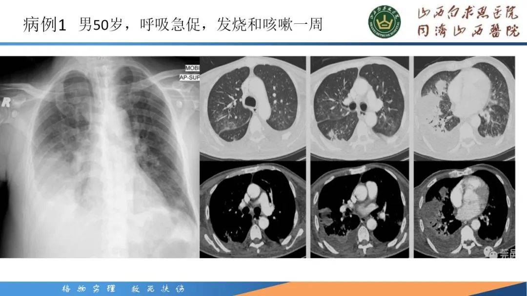 肺炎克雷伯杆菌感染影像学表现
