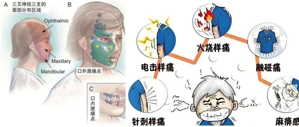 精准颅面神经阻击，破解满级剧痛密码_患者_治疗_亨特