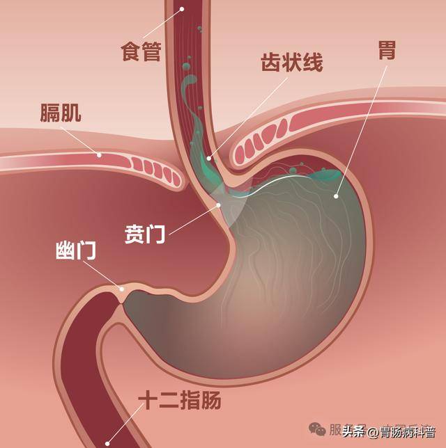 从解剖结构来看,贲门的环形肌肉在静止状态下保持一定张力,形成一个