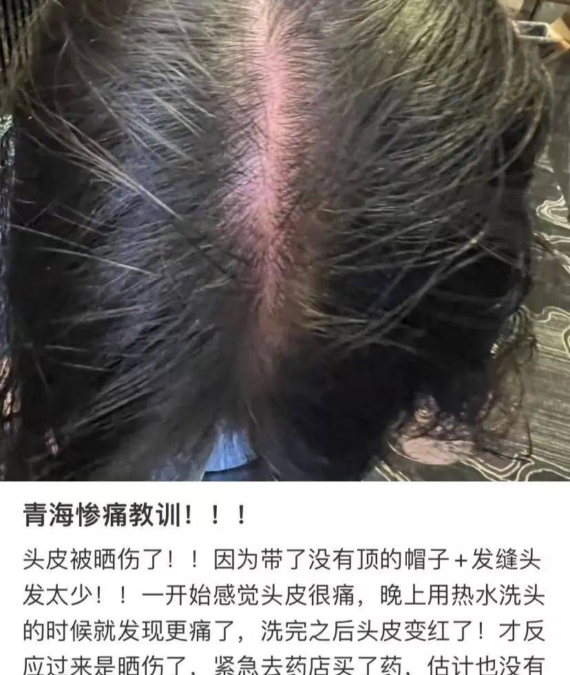 此生至甜吻你万千:【健康】夏天防晒，99%的人会忽略这个部位