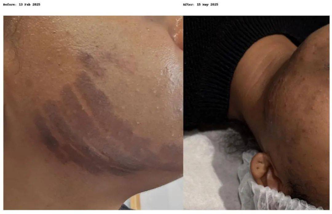 奥克兰女子去美容却被毁容,"脸皮都被烧掉了"