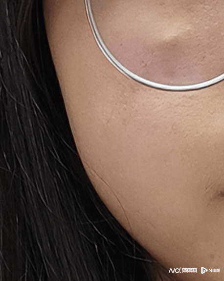 女子在深圳龙岗中心医院整形后留明显疤痕 院方:正常并发症(图3)