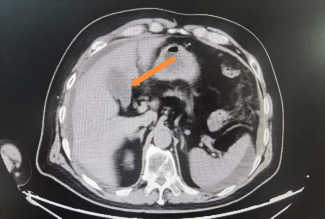 胆囊穿孔是一种严重且可能致命的急症,最常见于急性胆囊炎的并发症
