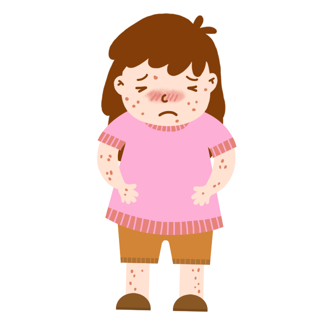 dermatitis)又叫特应性湿疹,俗称"痒醒症",呈慢性,复发性,炎症性皮肤