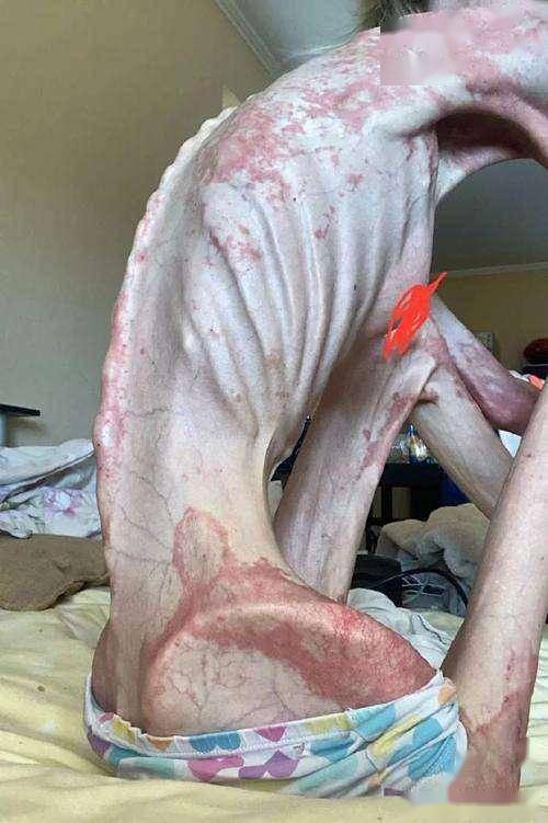 减肥找讨厌的人吃饭?当心厌食症.医生称想减肥找不喜欢的人一起