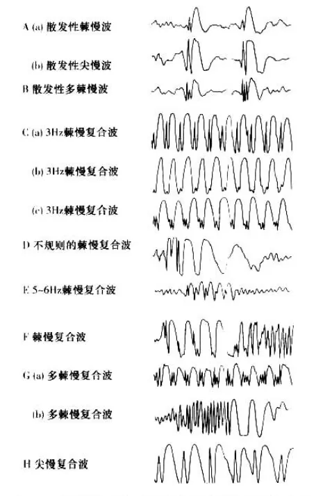 脑电图的 "正常" 与 "异常":波形特征及判断标准