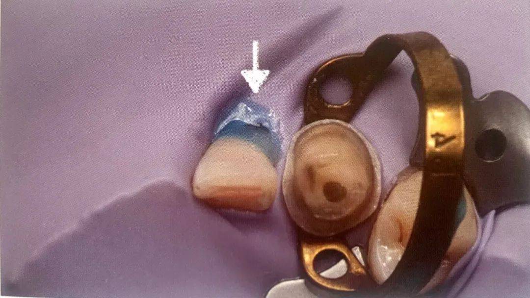 橡皮障使用过程中可能遇到5种问题请收藏备用