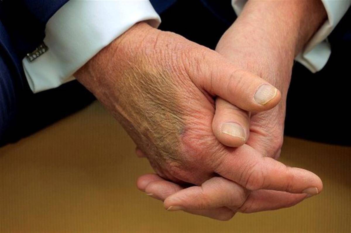 图片[2]-特朗普左手又添“新淤青”，白宫称“他握手太多”，他每天握手次数比美国历史上任何总统都多-华闻时空