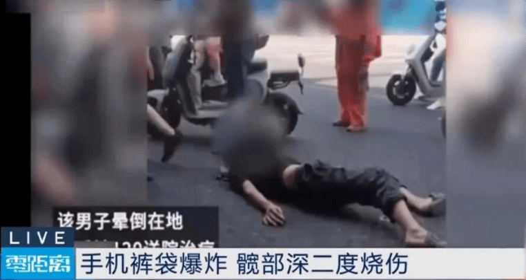 手机突然爆炸，3岁男童被烧伤！