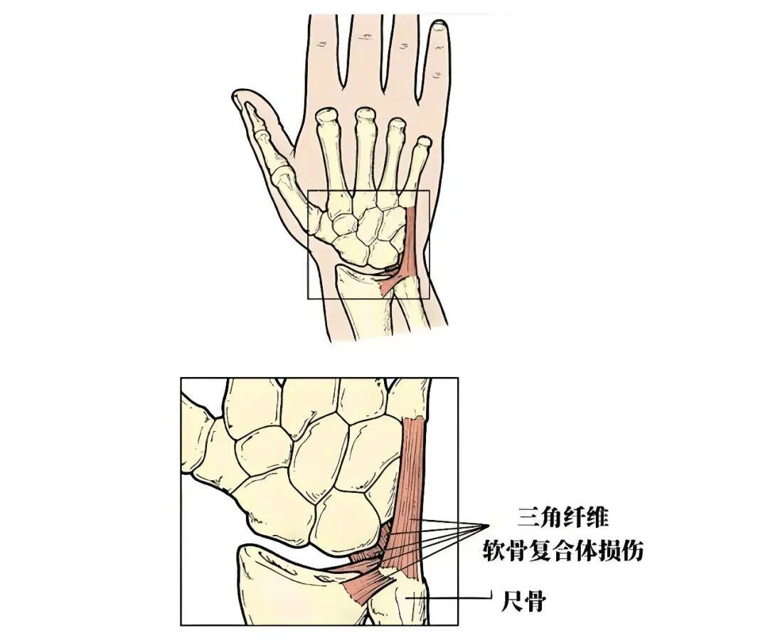 可能是"腕关节小垫片"坏了