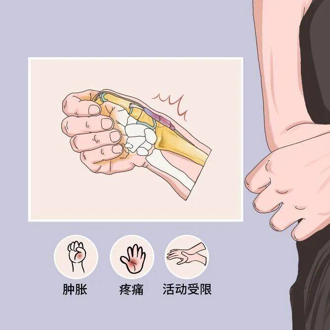 【健康科普】手指疼、麻木、活动受限？这3种常见手部疾病，别再当成“累的”_关节_神经_肌腱
