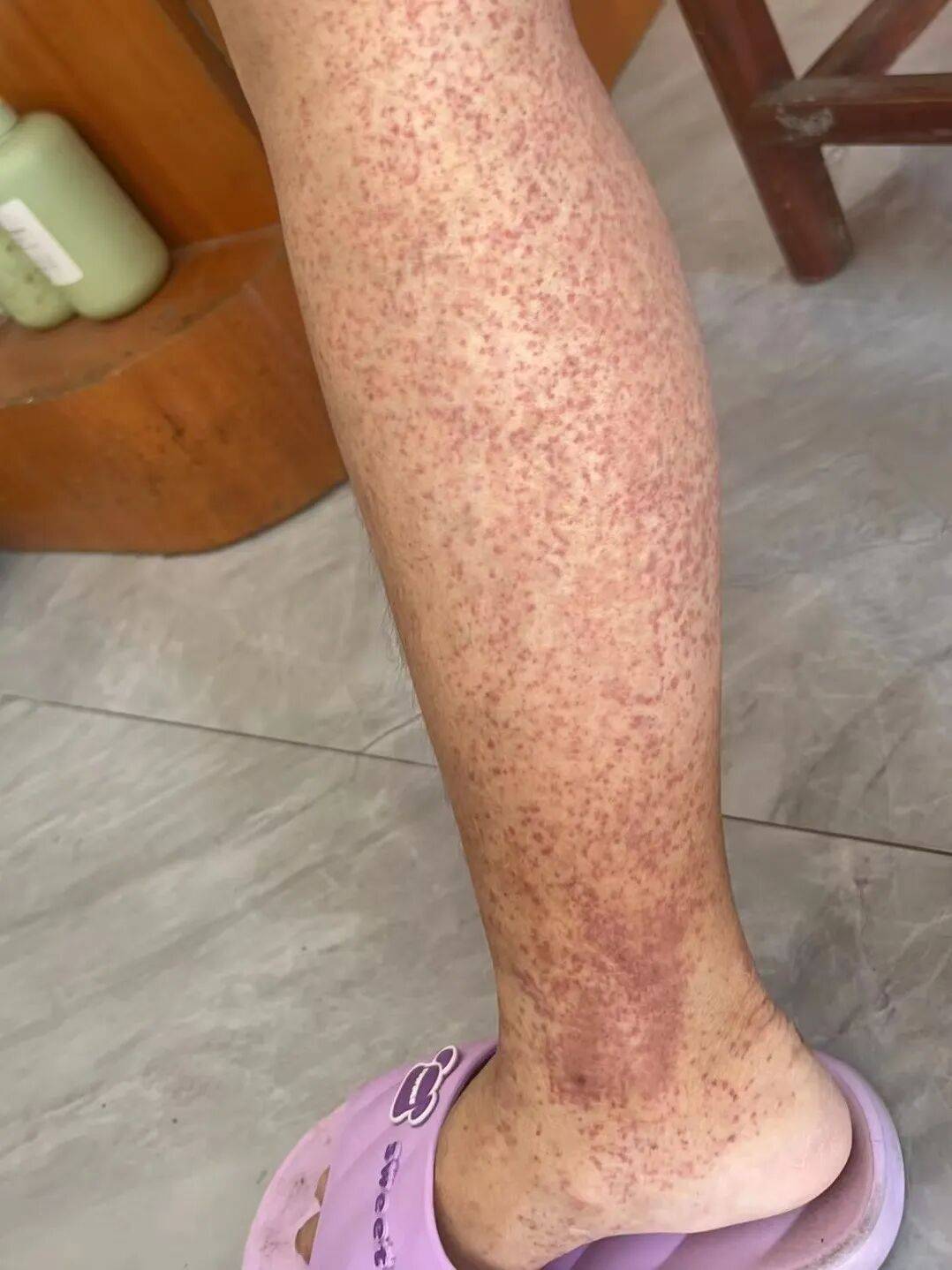 知名演员自曝脸肿到没法见人,15岁女孩四肢布满芝麻大的出血点!