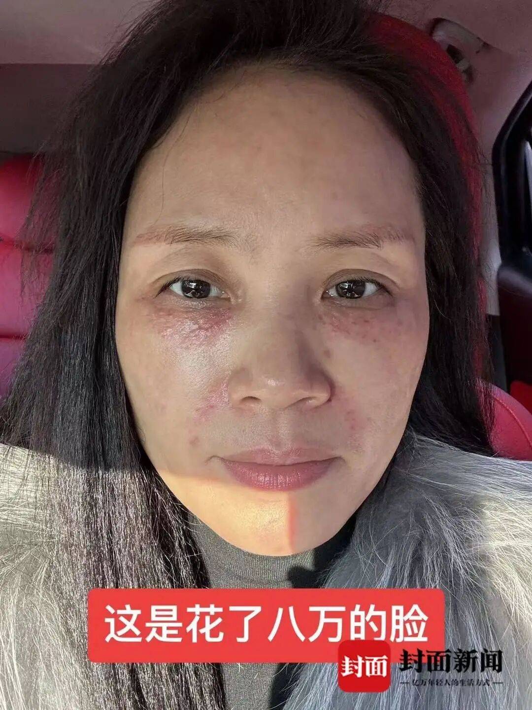 女子花7万元整形失败欲退款 辗转4家医院维权遭遇“踢皮球”(图2)