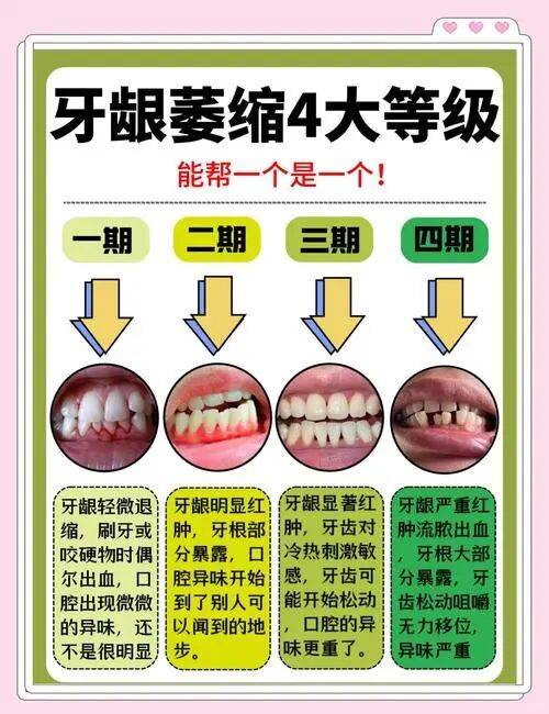 牙缝里的“肉”没了，可能再也回不来了！3个方法对镜自测牙龈萎缩！